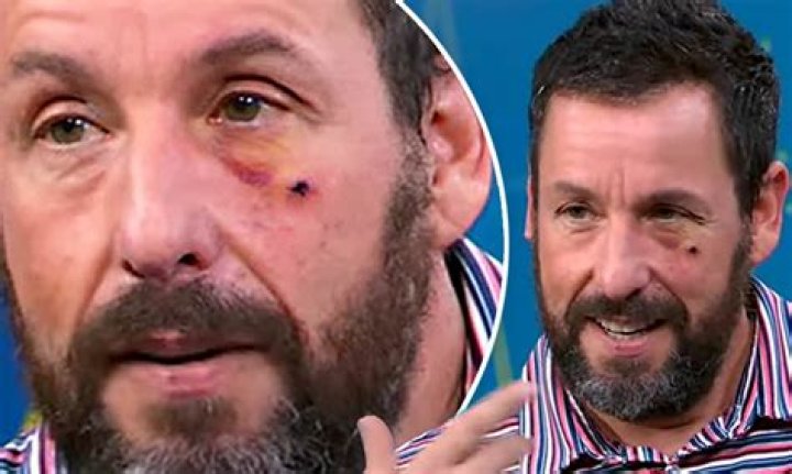 Adam Sandler Sports A Black Eye On ‘GMA’ & Reveals How He Got the Injury