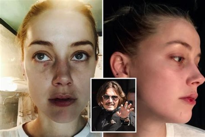 Amber Heard & Johnny Depp: Scary Bruises, Broken Glass & Evidence Of Her Abuse Claims