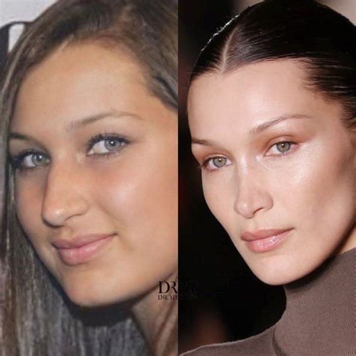Bella Hadid Confirms She Had A Nose Job After Denying Plastic Surgery – Hollywood Life