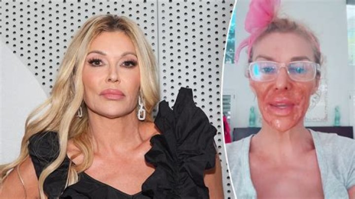 Brandi Glanville Hospitalized With Mysterious Infection — See Her Brutal Hand Injury
