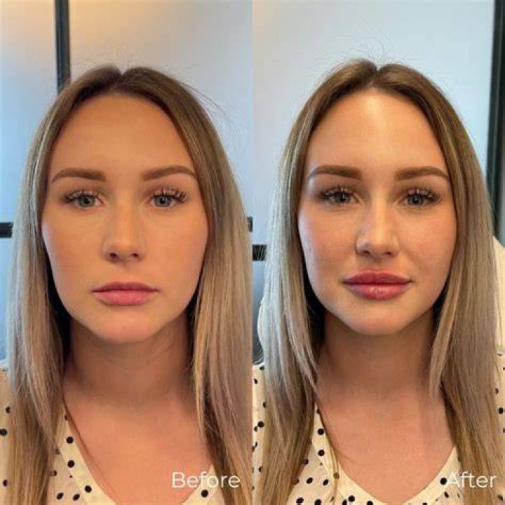 Brielle Biermann, 22, Shows Off Her Smaller Lips After Removing Her Fillers — See Before & After Pics