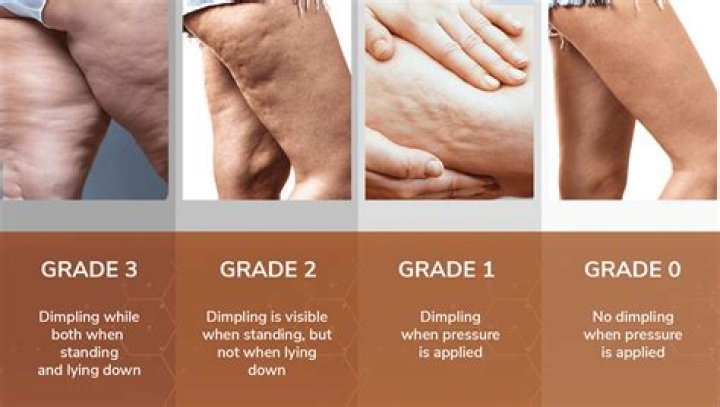 ‘Cellulite Is Normal’ – Hollywood Life
