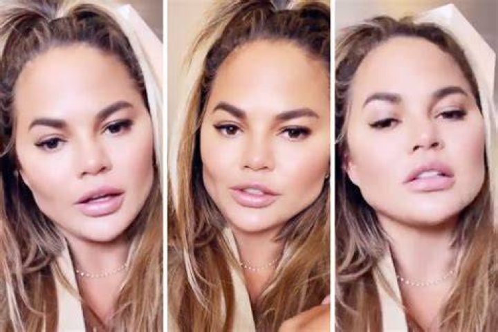 Chrissy Teigen Reveals She Got Cheek Fat Removed In Cosmetic Surgery – Hollywood Life