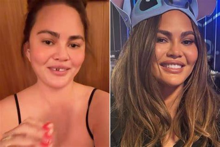 Chrissy Teigen Shockingly Loses A Tooth After She Bites Into A Fruit Roll-Up