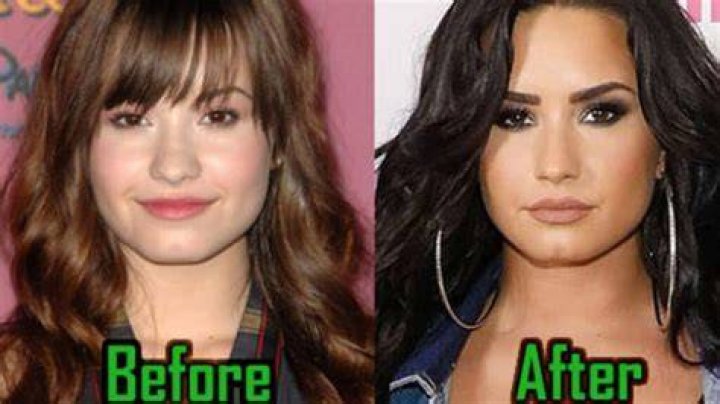 Demi Lovato’s Illness After Alleged OD Sounds Like Withdrawal Symptoms, Doctor Explains