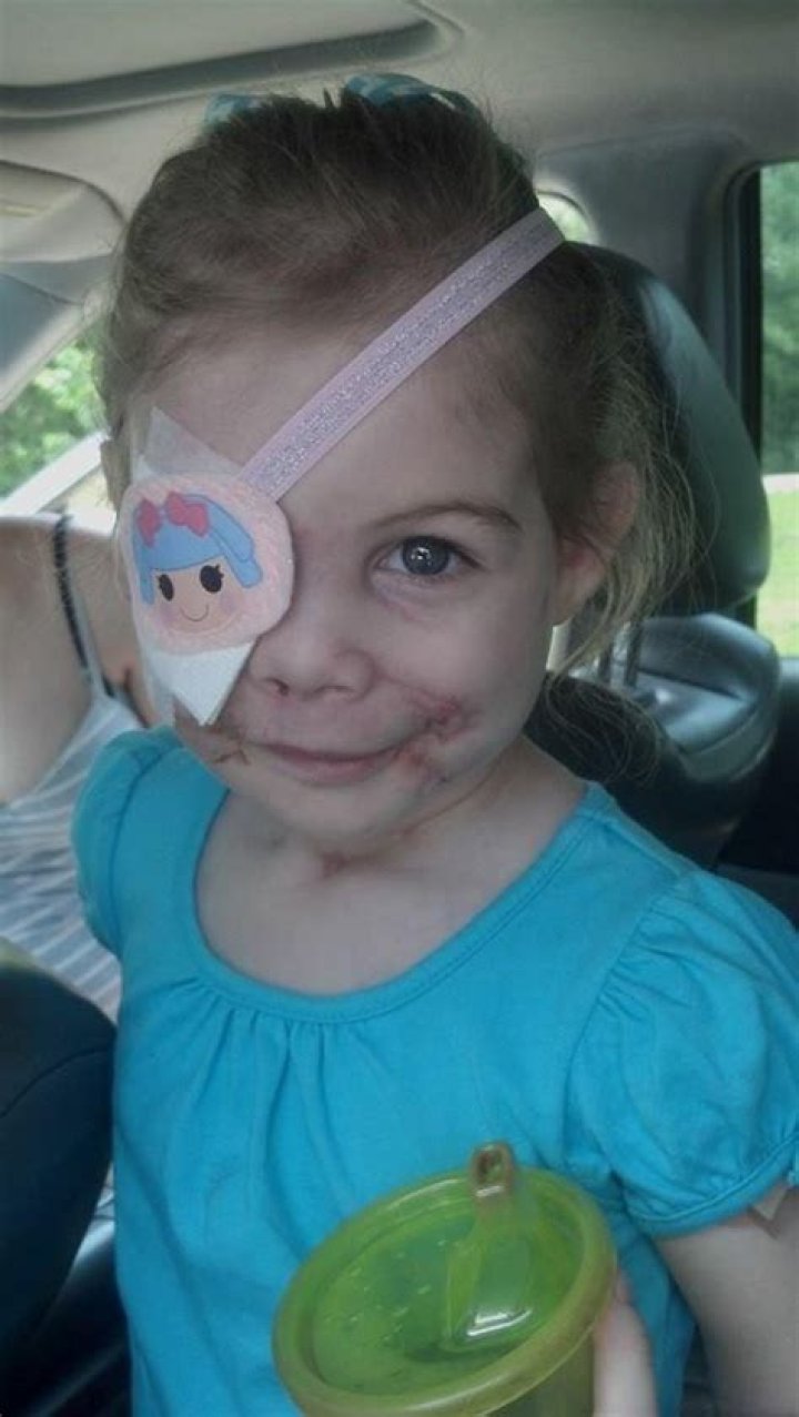 Disfigured Girl, 3, Asked To Leave KFC — Was It A Hoax?