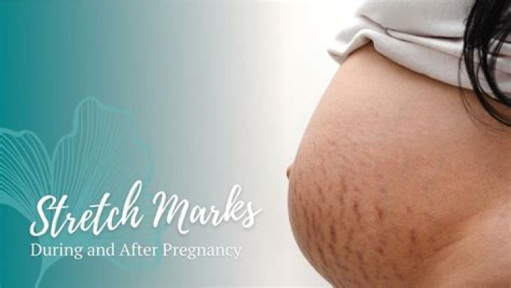How Kate Middleton Avoids Stretch Marks While Pregnant — Report