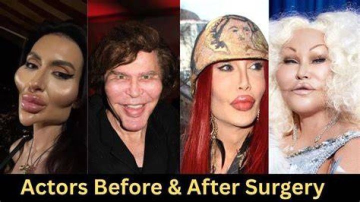 How They Changed After Plastic Surgery – Hollywood Life