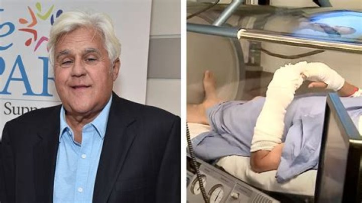 Jay Leno Burned In His Face After Car Fire – Hollywood Life