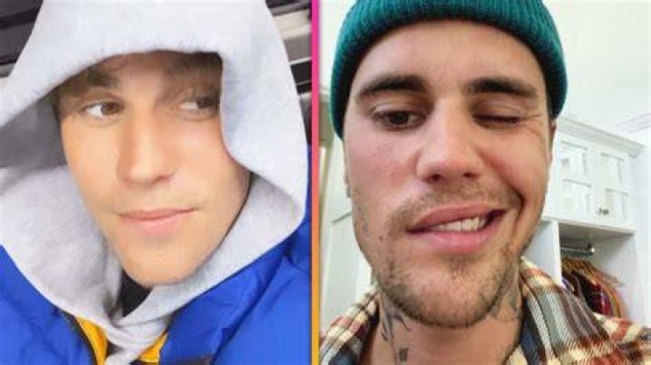 Justin Bieber’s Face Is Paralyzed Due To Ramsay Hunt Syndrome – Hollywood Life