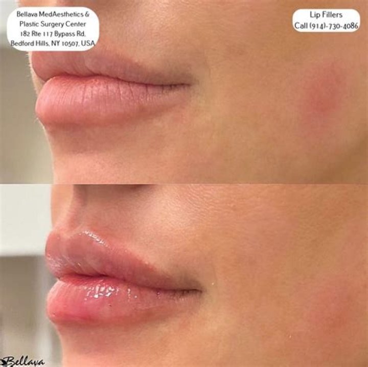 Kathy Griffin Shows Off Swollen Lips After ‘Blushing’ Procedure – Hollywood Life