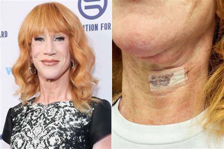 Kathy Griffin Undergoes Vocal Cord Surgery Amid Ongoing Lung Cancer Battle