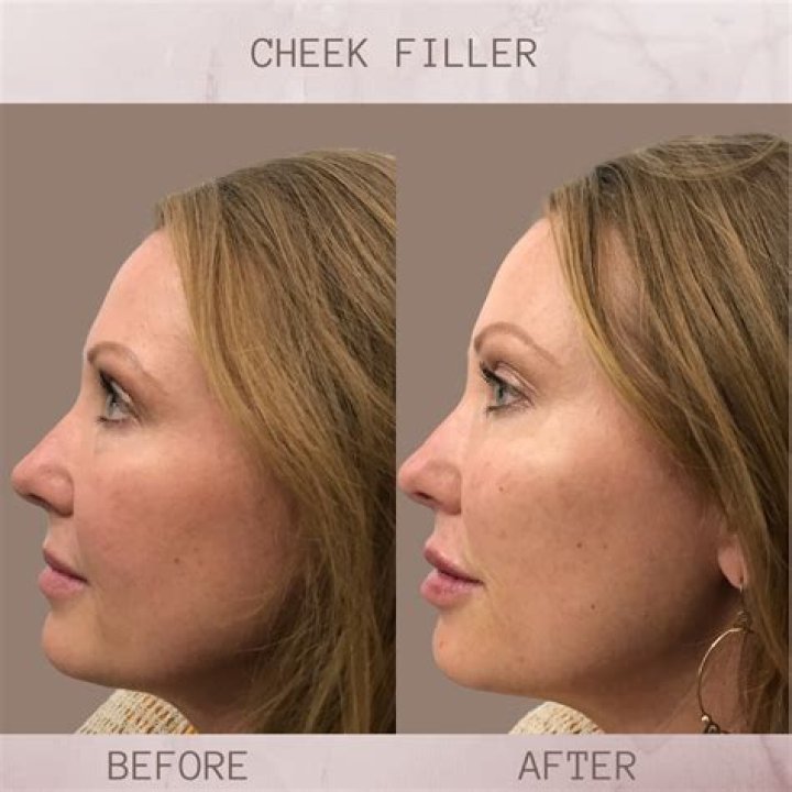 Khloe Kardashian ‘Very Likely’ Used Fillers To Achieve Fuller Cheeks & A Contoured Jawline