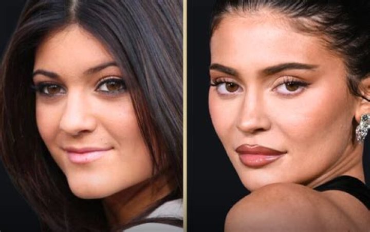 Kylie Jenner’s Lips Look More Enormous Than Ever One Month After Giving Birth: See Wild Pic