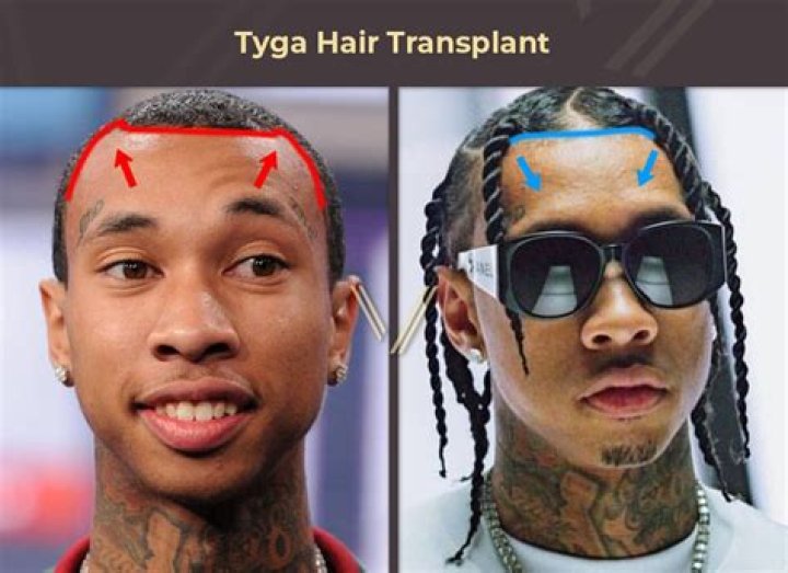 Kylie Jenner & Travis Scott: Their Reaction To Nicki Minaj Outing Tyga For Having Hair Transplant