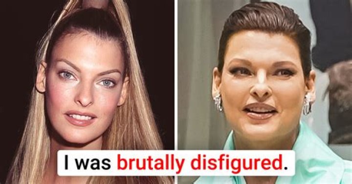 Linda Evangelista Admits She Still Gets Botox After Being ‘Brutally Disfigured’ By CoolSculpting Procedure