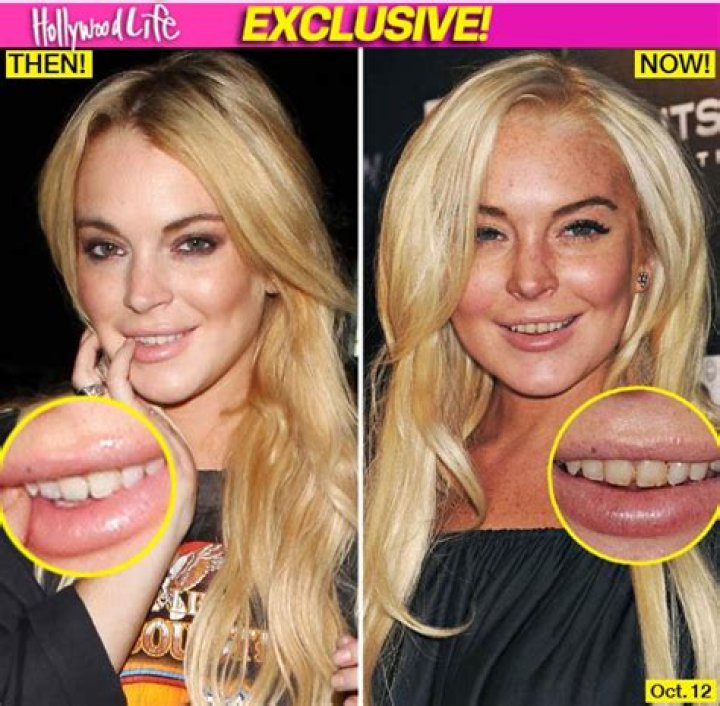 Lindsay Lohan's Tooth Decay Caused By Cigarettes, Poor Hygiene & Possible Drug Use! – Hollywood Life