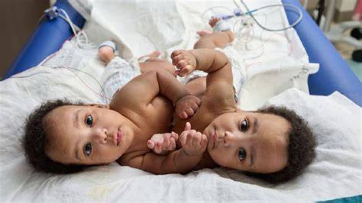 [PHOTOS] Australian Baby Two Faces, Conjoined Twins Faith & Hope Born In Sydney – Hollywood Life
