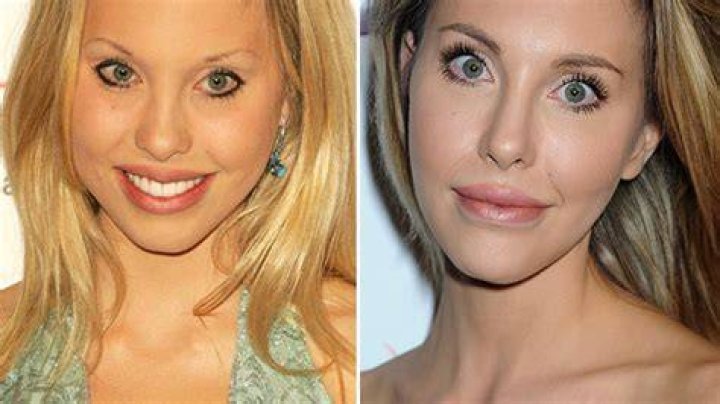 [PICS] Chloe Lattanzi’s Plastic Surgery Before & After Pics: – Hollywood Life