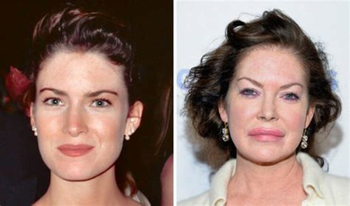 Plastic Surgery On Face? — See Before & After Pics – Hollywood Life