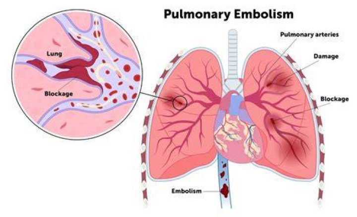 Pulmonary Embolism: What Duane Chapman’s Dangerous Condition Is & How It’s Treated: Docs Explain