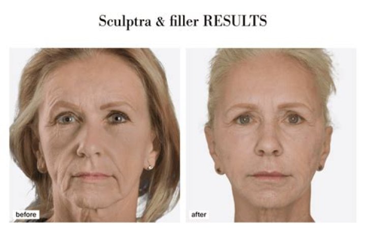Sculptra — The Newest & Best Filler To Get The Celebrity Look – Hollywood Life