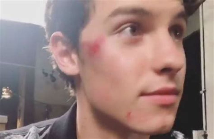 Shawn Mendes Reveals Painful Bruises On His Face After Scary Scooter Accident: Is He OK?