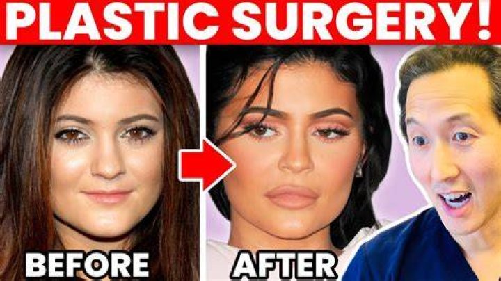 Snapchat Filters Inspiring Plastic Surgery — Would You Spend $2,000 To Look Perfect?