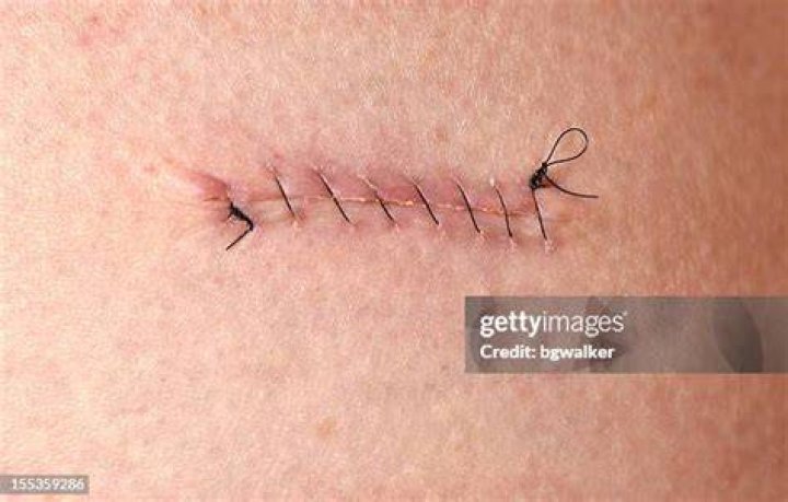 Stitches — PICS