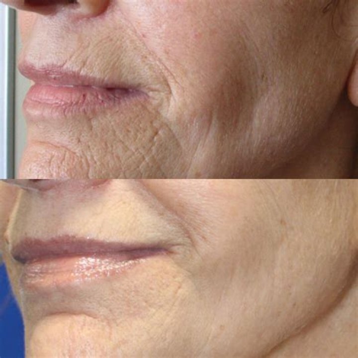 This Celeb-Loved Beauty Roller Helps Lift Skin While Reducing The Appearance Of Wrinkles