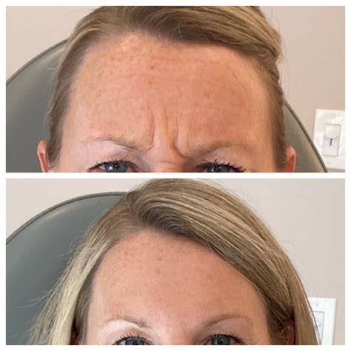 TikTok Is Raving About This Botox Alternative That Can Smooth Forehead Lines In One Night