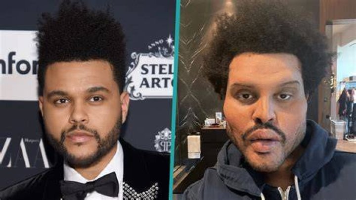 What Happened To The Weeknd’s Face? Shocking News – Hollywood Life