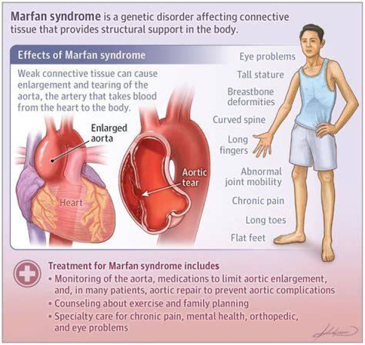 What Is Marfan Syndrome? 5 Things About Isaiah Austin’s Genetic Disorder – Hollywood Life